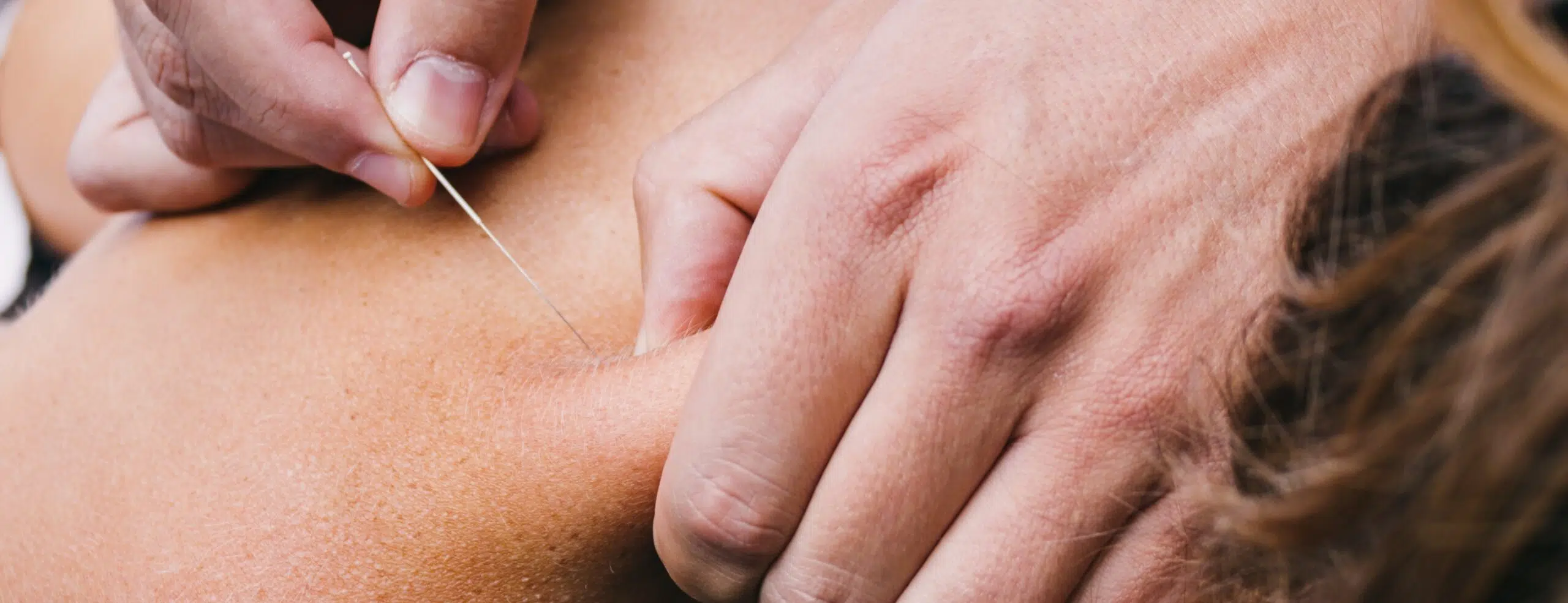 Dry Needling par un kinésithérapeute du sport à Paris